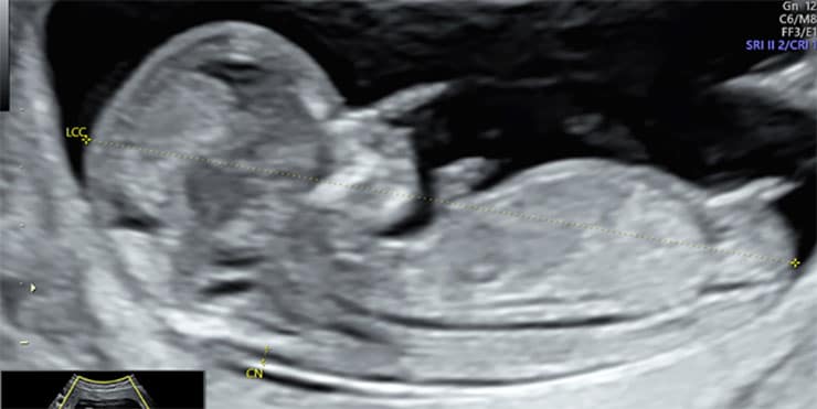 échographie sage femme bonneville