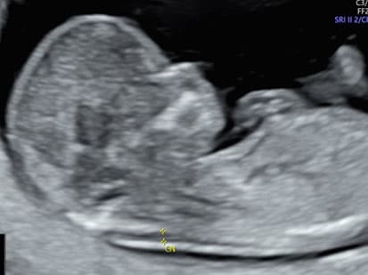 échographie sage femme bonneville