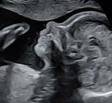 échographie sage femme bonneville