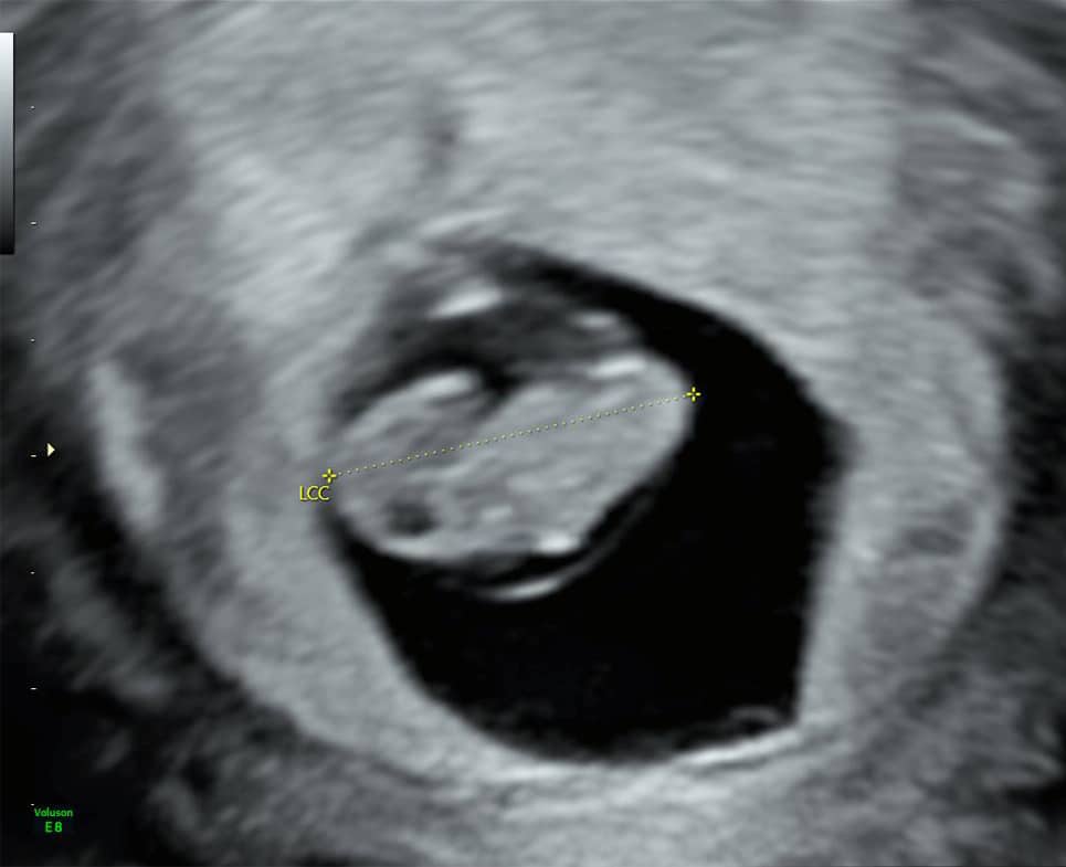 echographie datation