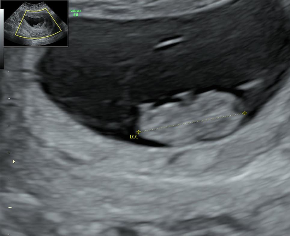 echographie datation