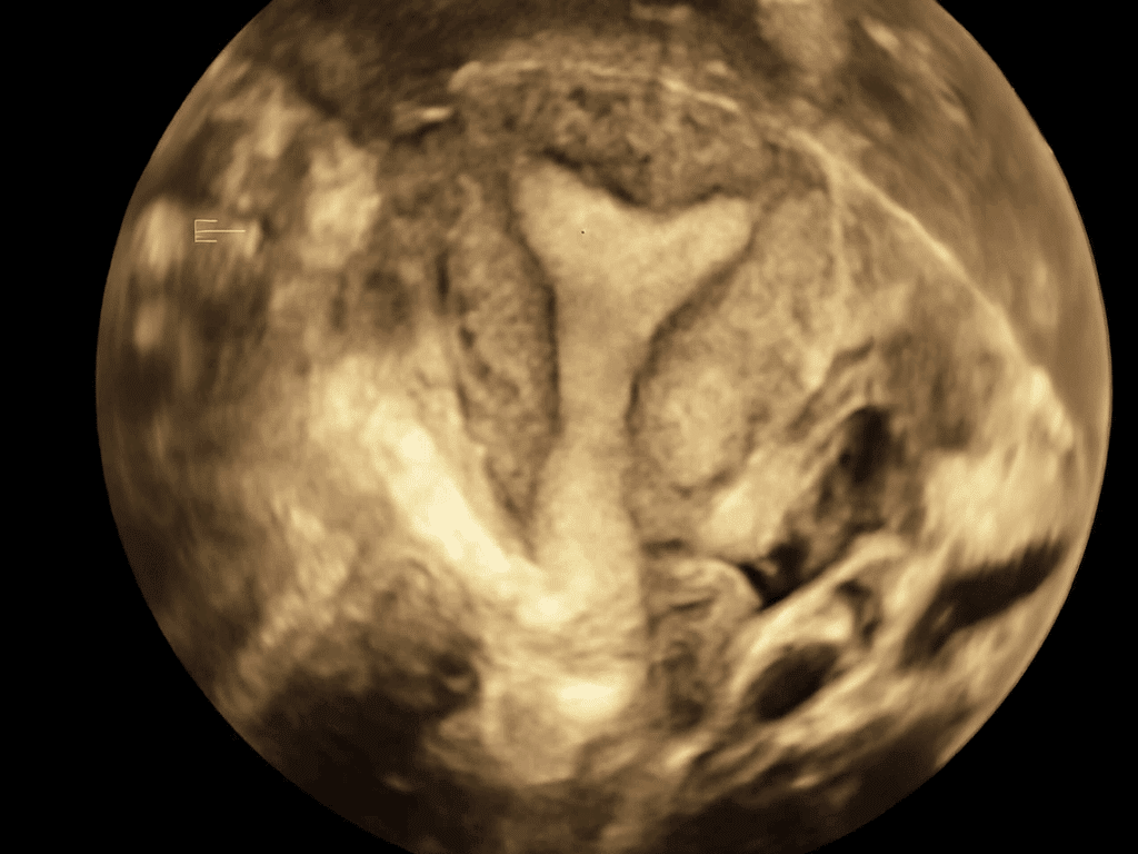 Échographie gynécologique